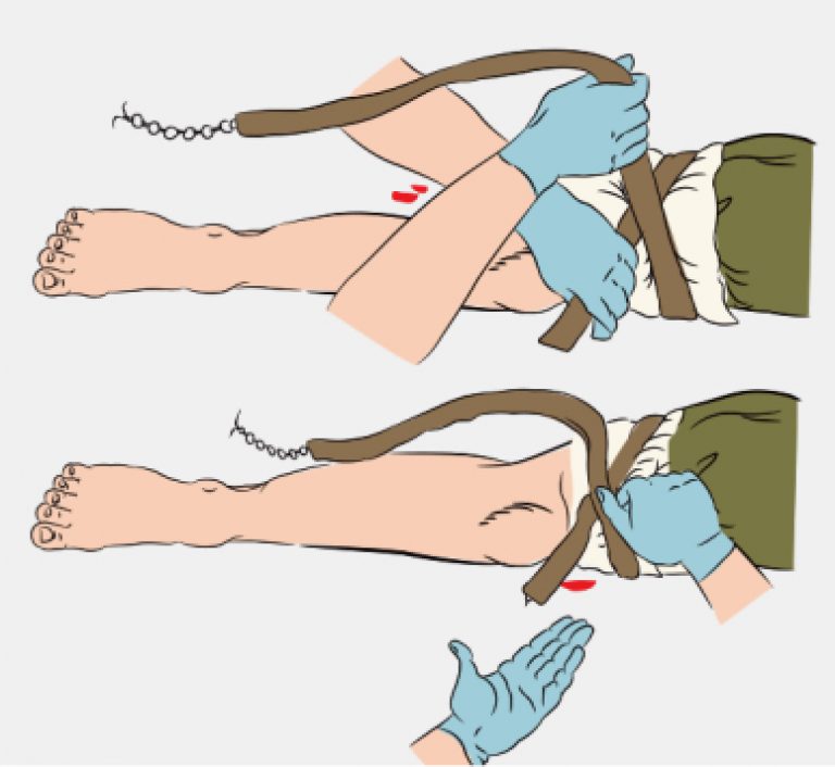 Кровотечение бедра. Жгут для остановки кровотечения при ранении. Остановка артериального кровотечения с помощью жгута. Остановка кровотечения при переломе. Наложение кровоостанавливающего жгута рисунок.